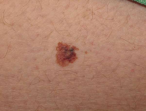 Benign Nevus (ICD-10: D22) – Skinive