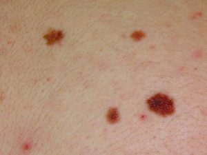 Types of skin moles and how to know if they’re safe - Online AI ...