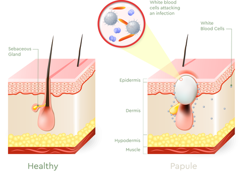 What Type of Acne Do You Have? Types of Acne Explained ... back acne diagram 