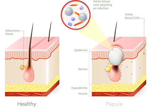 What Type of Acne Do You Have? Types of Acne Explained - Skinive - Free ...