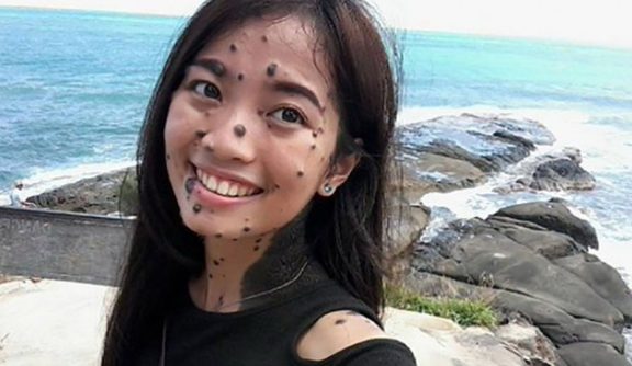 Woman Born With Moles All Over Her Body Is Trying Out for Miss Universe