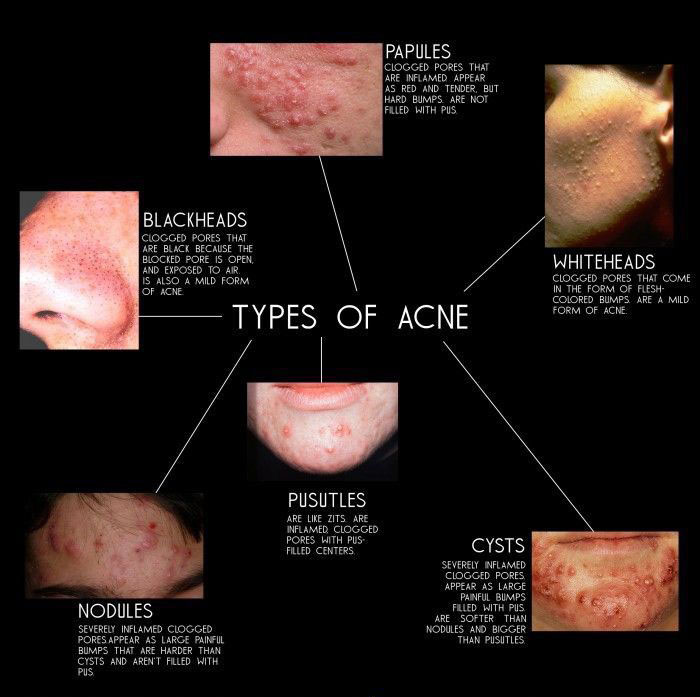 What Can You Do About acne Right Now