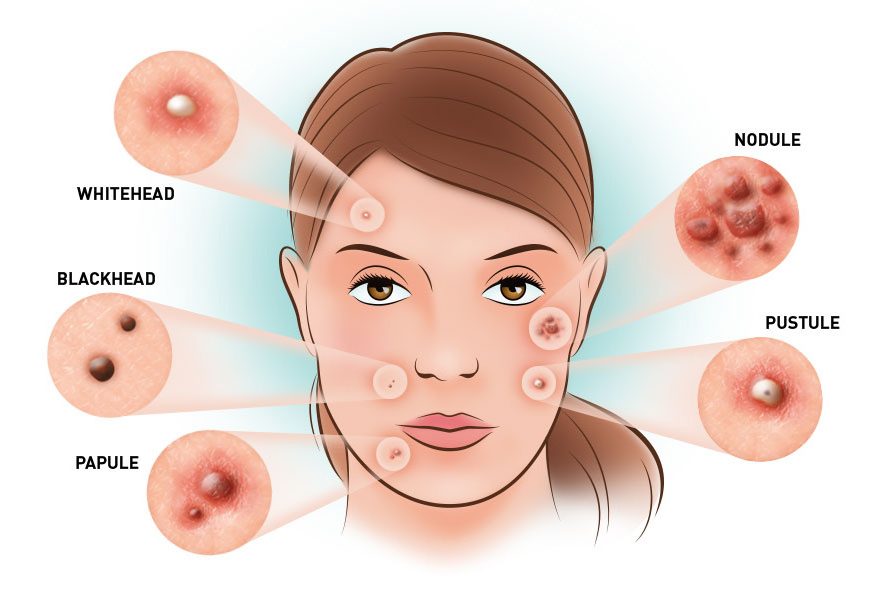 papules and pustules