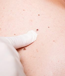 Skin Cancer Self-examinations: Understand Your Risks