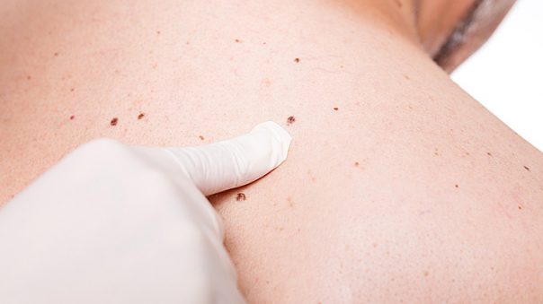 Skin Cancer Self-examinations: Understand Your Risks