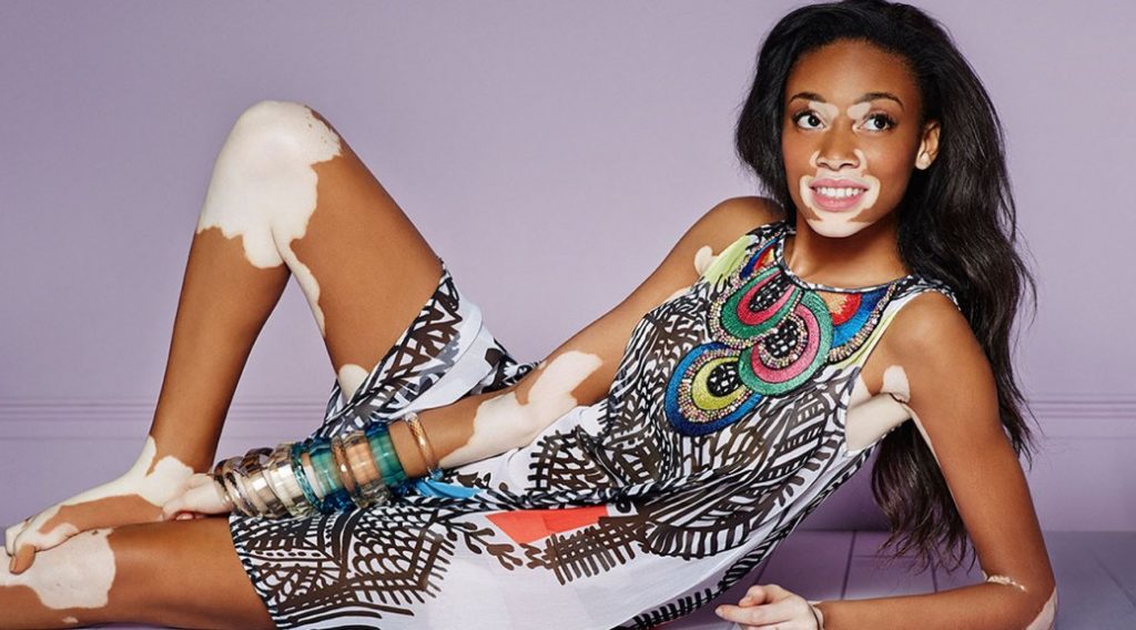 Winnie Harlow Is the Newest Victoria's Secret Model, & Will Walk