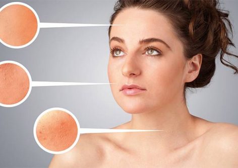 What Type of Acne Do You Have? Types of Acne Explained