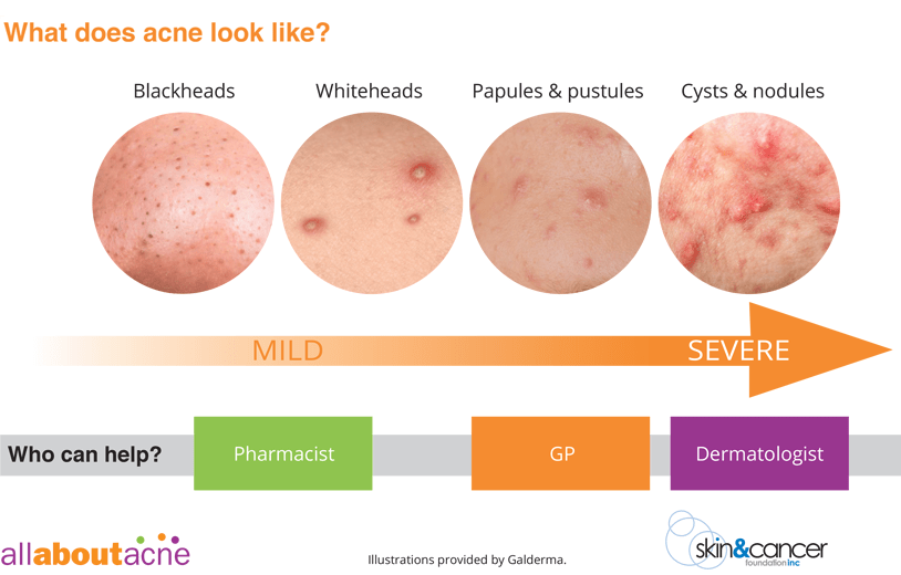 what is the acne types