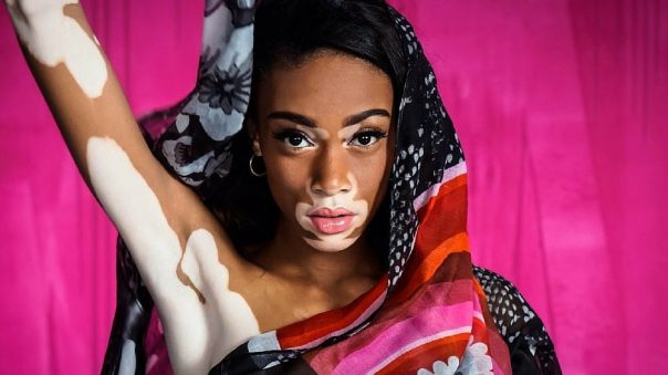 The First Model With Vitiligo To Be Cast By Victoria’s Secret