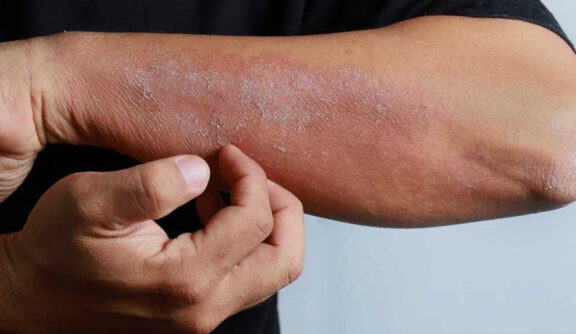 Eczema & Dermatitis: Types, Symptoms and Treatment