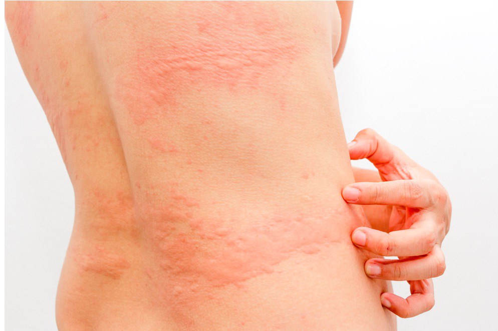 How May Coronavirus Symptoms Covid 19 Manifest On The Skin Skinive