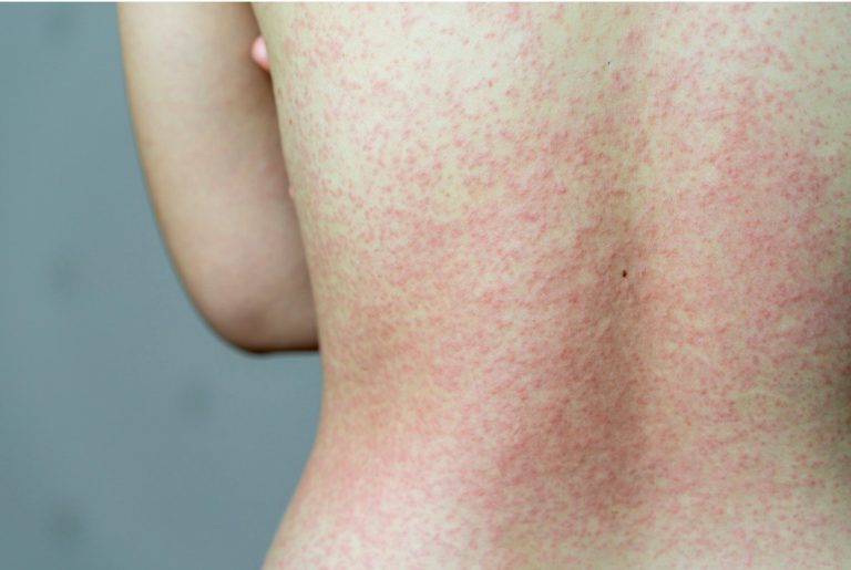 Can A Viral Rash Look Like Hives