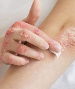 Dermatoses papulosquameuses : psoriasis, dermatite et lichen.
