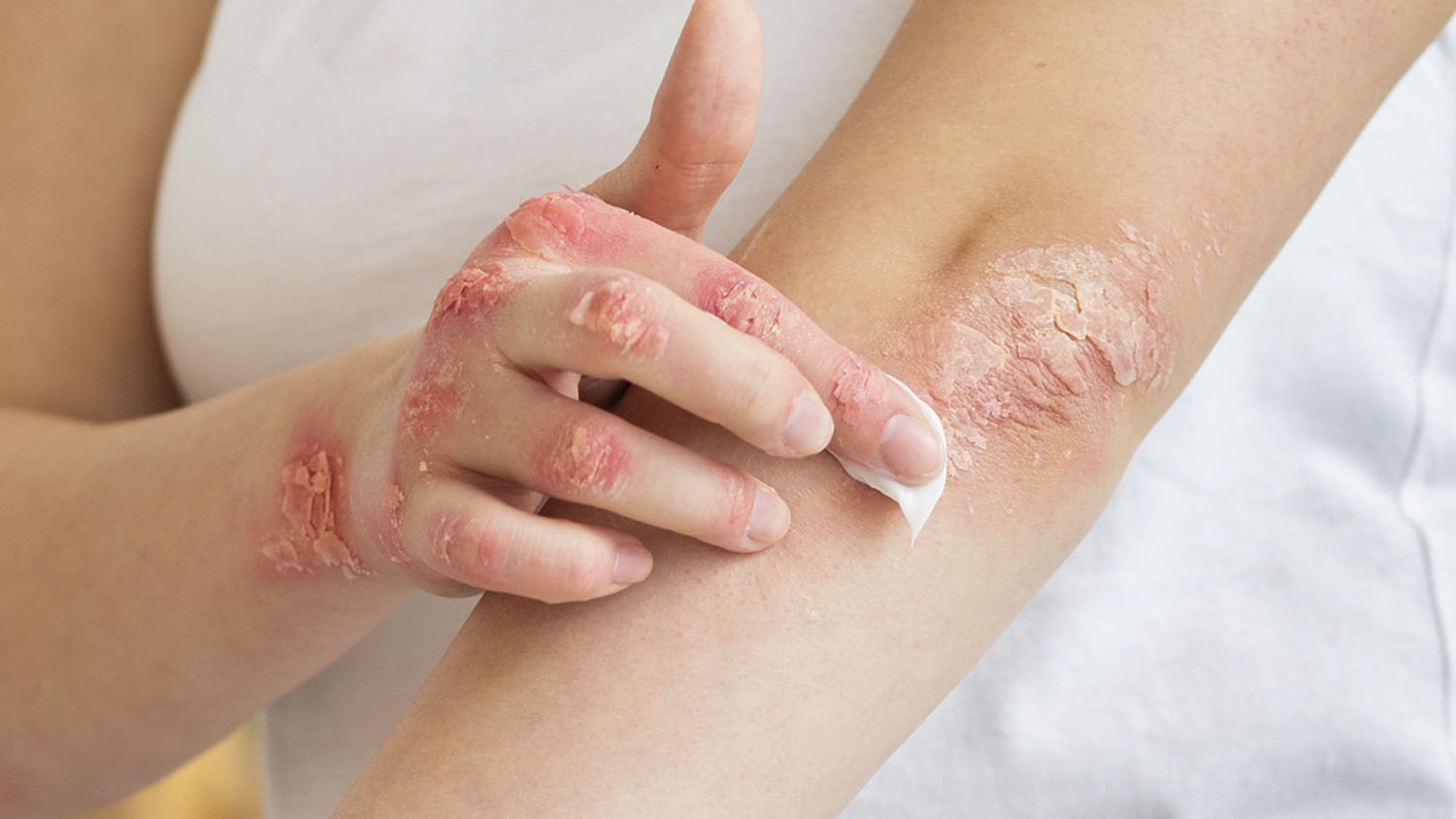 Contact Dermatitis to Nail Cosmetics | Current Dermatology Reports