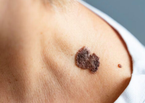 Precancerous moles (Neoplasms): Guide to Skin Anomalies