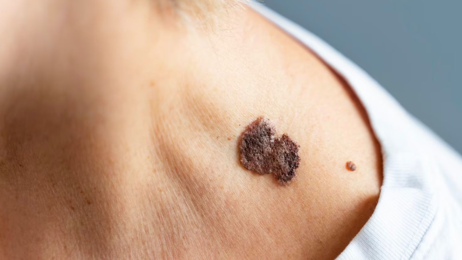 Precancerous Moles Neoplasms Guide To Skin Anomalies