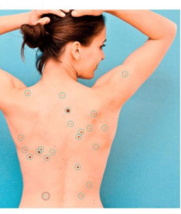 Mole mapping – what is it and how to get your moles mapped?