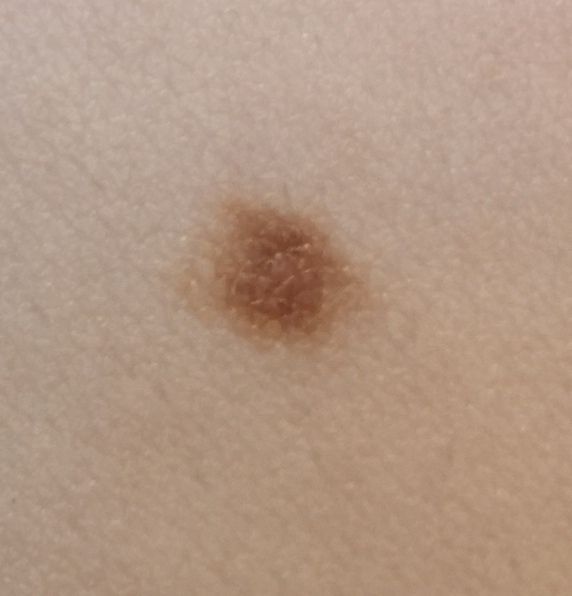 Benign nevus