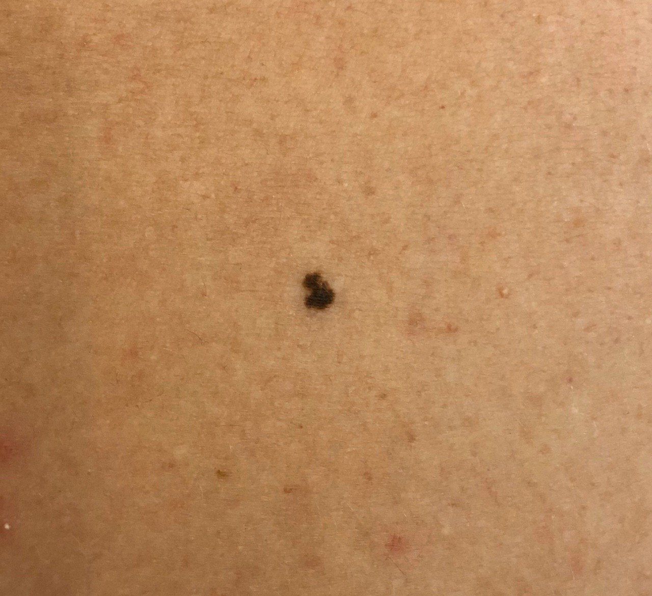 Melanoma