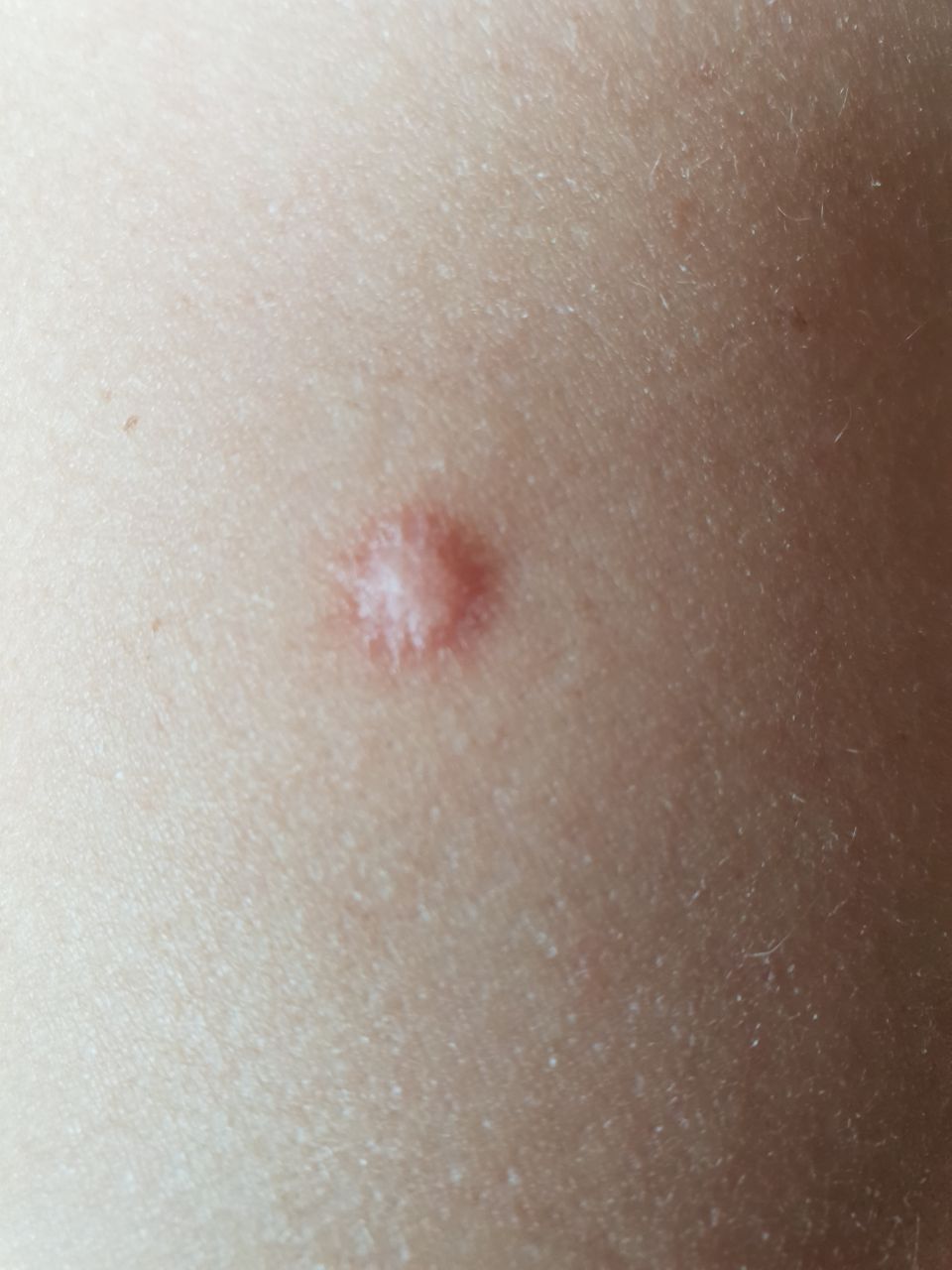 Dermatofibrom Symptome Bilder KI Check ICD 10 D23 ICD 11 2F23 Dermatofibrom Symptome Bilder KI Check ICD 10 D23 ICD 11 2F23