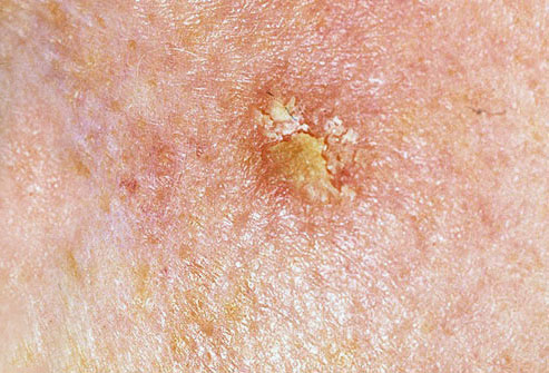 Actinic keratosis