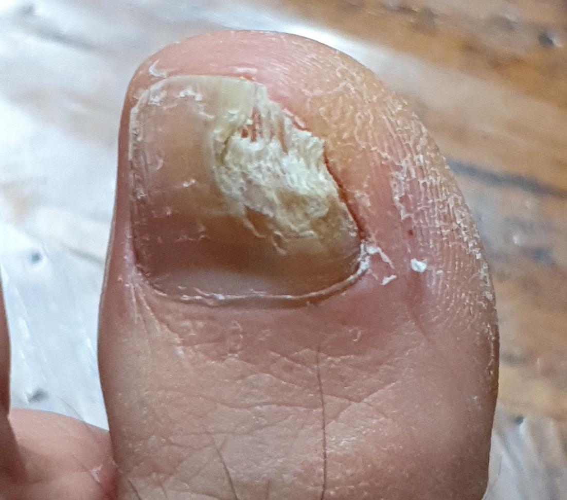 Nail mycosis