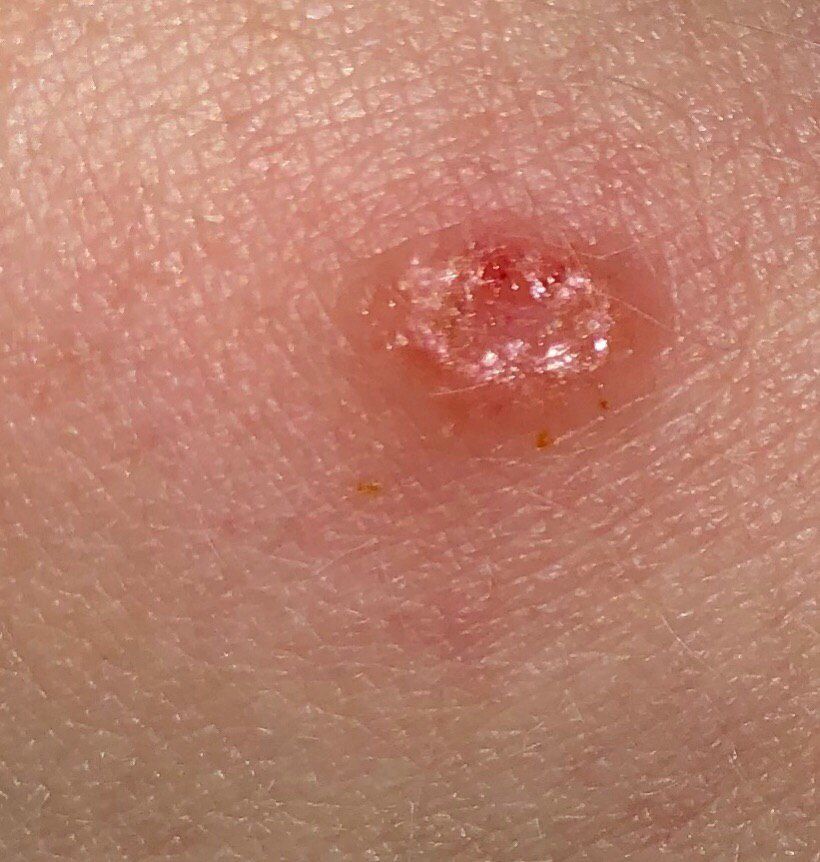 Basal cell carcinoma