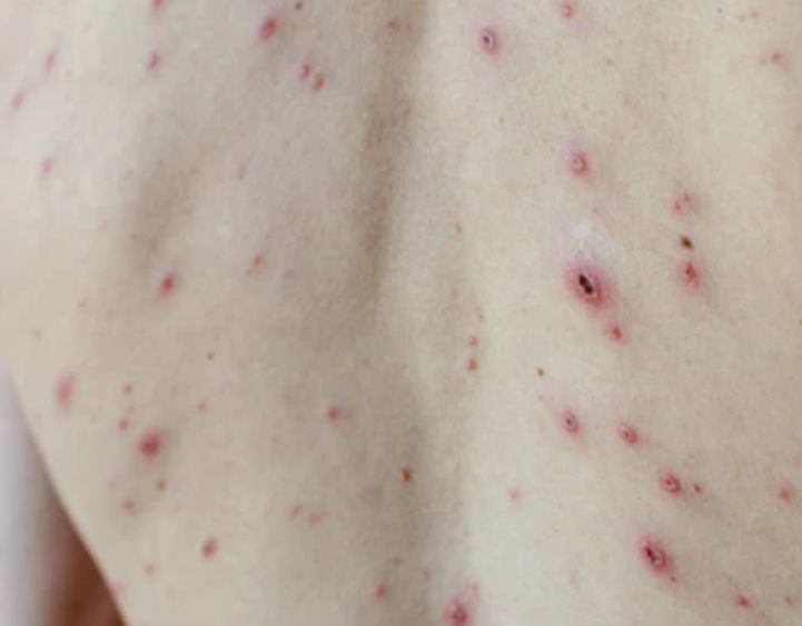 Herpes Varicella Zoster

