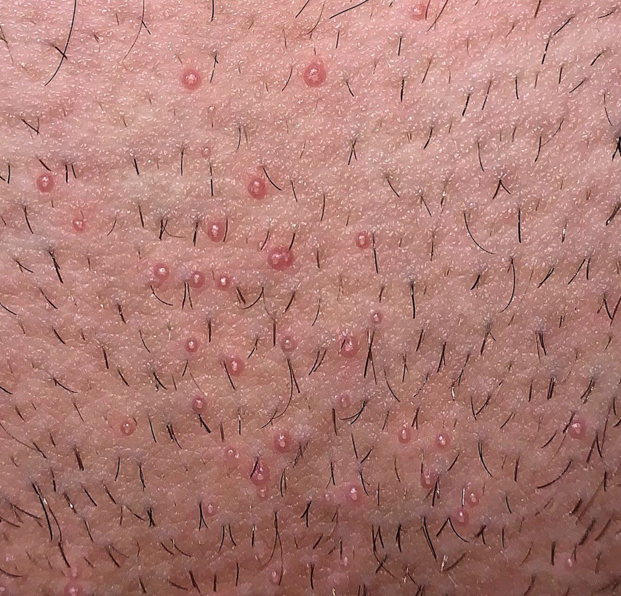 molluscum contagiosum