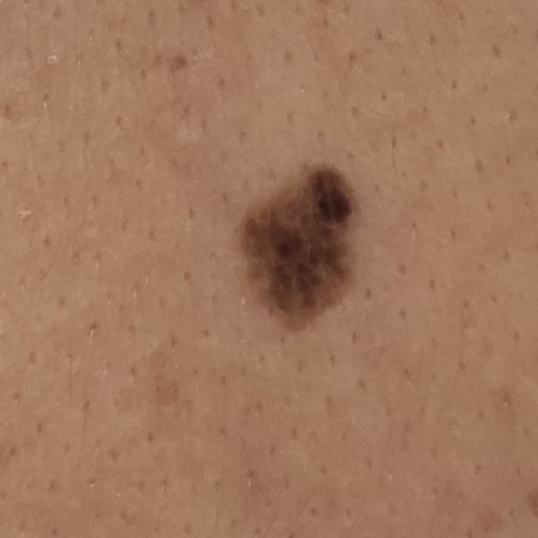 atypical nevus
