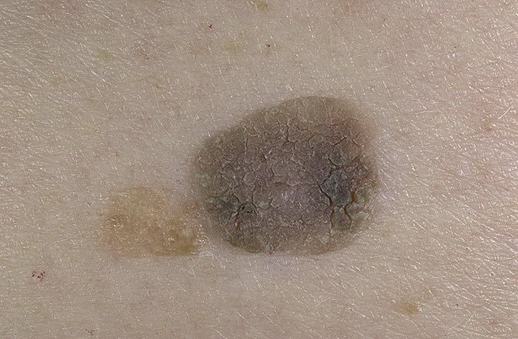 Seborrheic keratosis