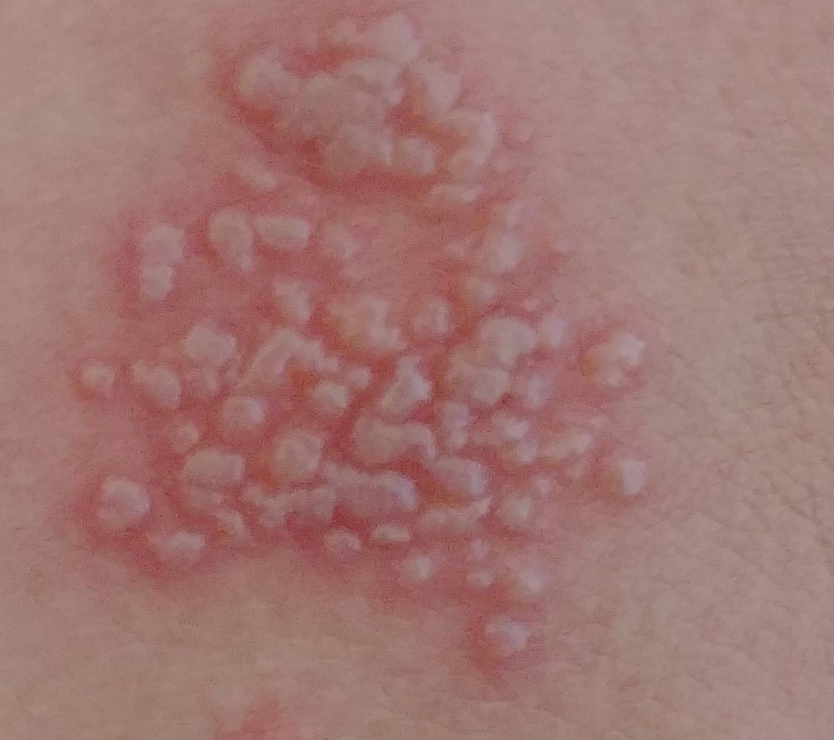 Herpes Simplex Virus Icd 10