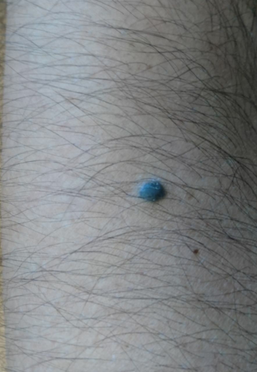 Blue Nevus