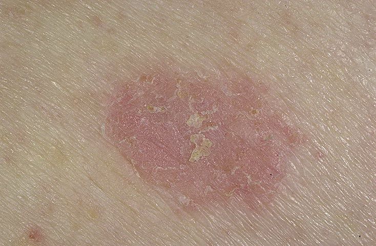 precancerous keratosis