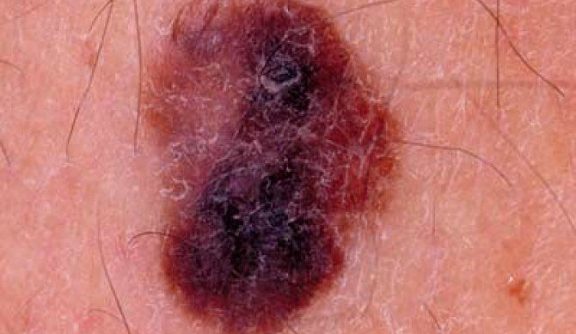皮膚腫瘍 黒色腫（ICD-11: 2C30 / ICD-10: C43）🚨 - Online AI Dermatologist