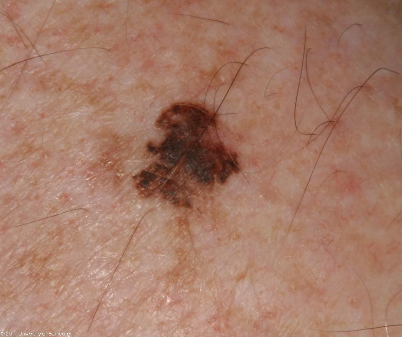 Lentigo Melanoma