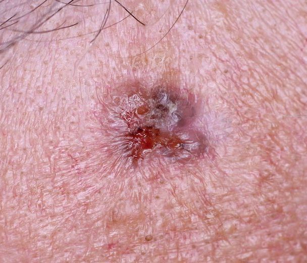 Basal cell carcinoma (ICD-10: C44) - Online consultation AI dermatologist