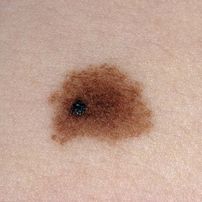 Dysplastic Nevus