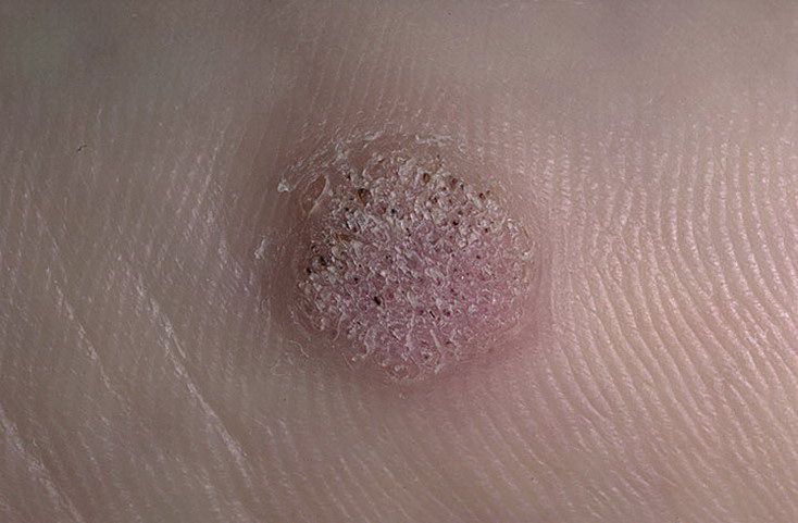 Common wart