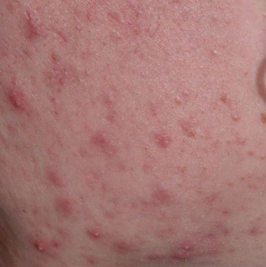 Common pimples
