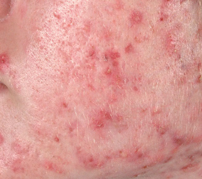 Common acne