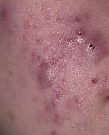 acne cystic