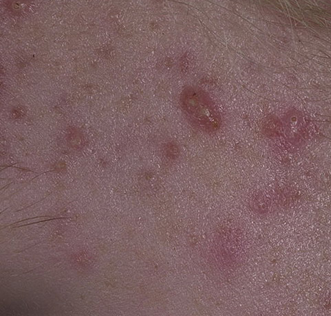 acne cystic