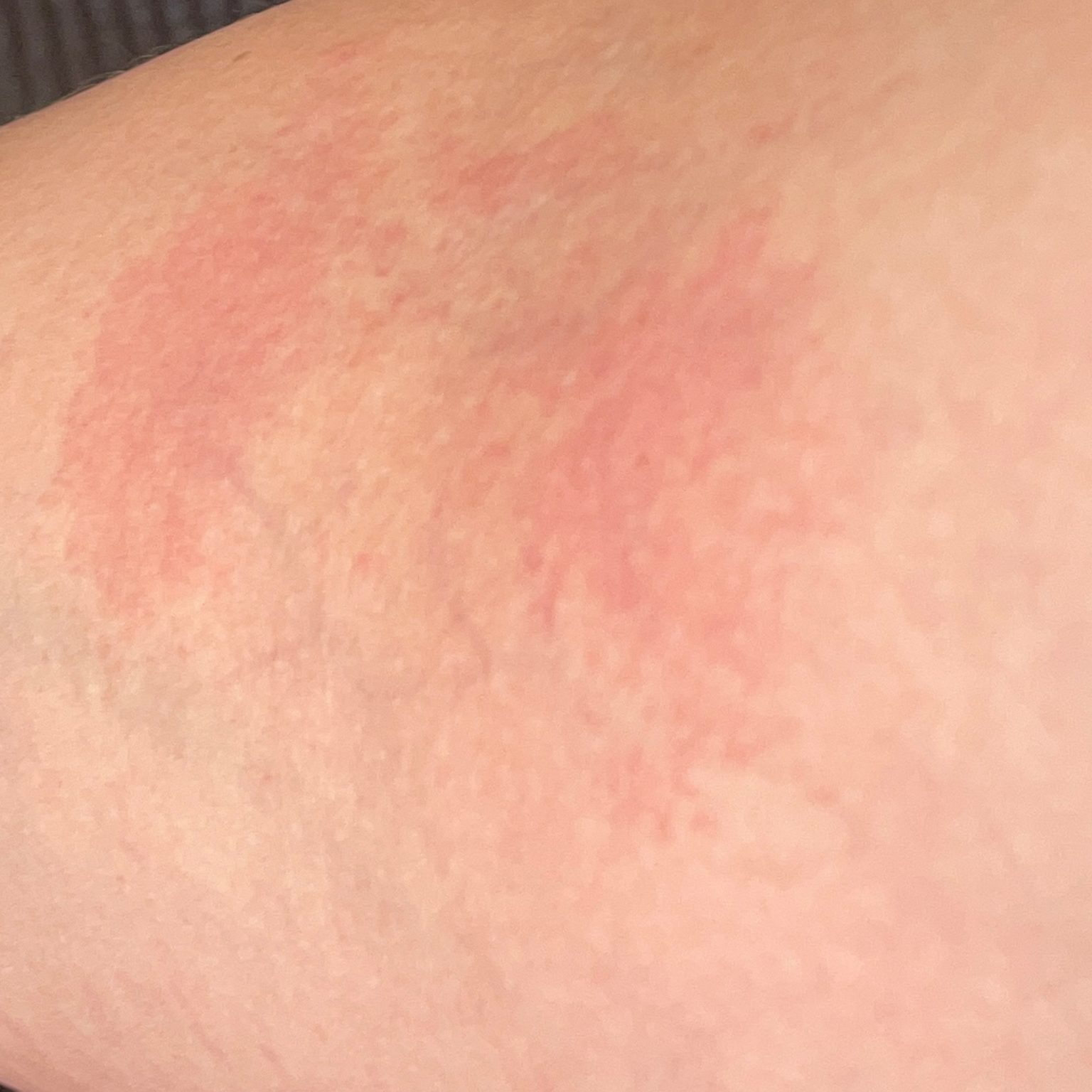 Dermatitis (ICD10 L20L30) Online AI Dermatologist