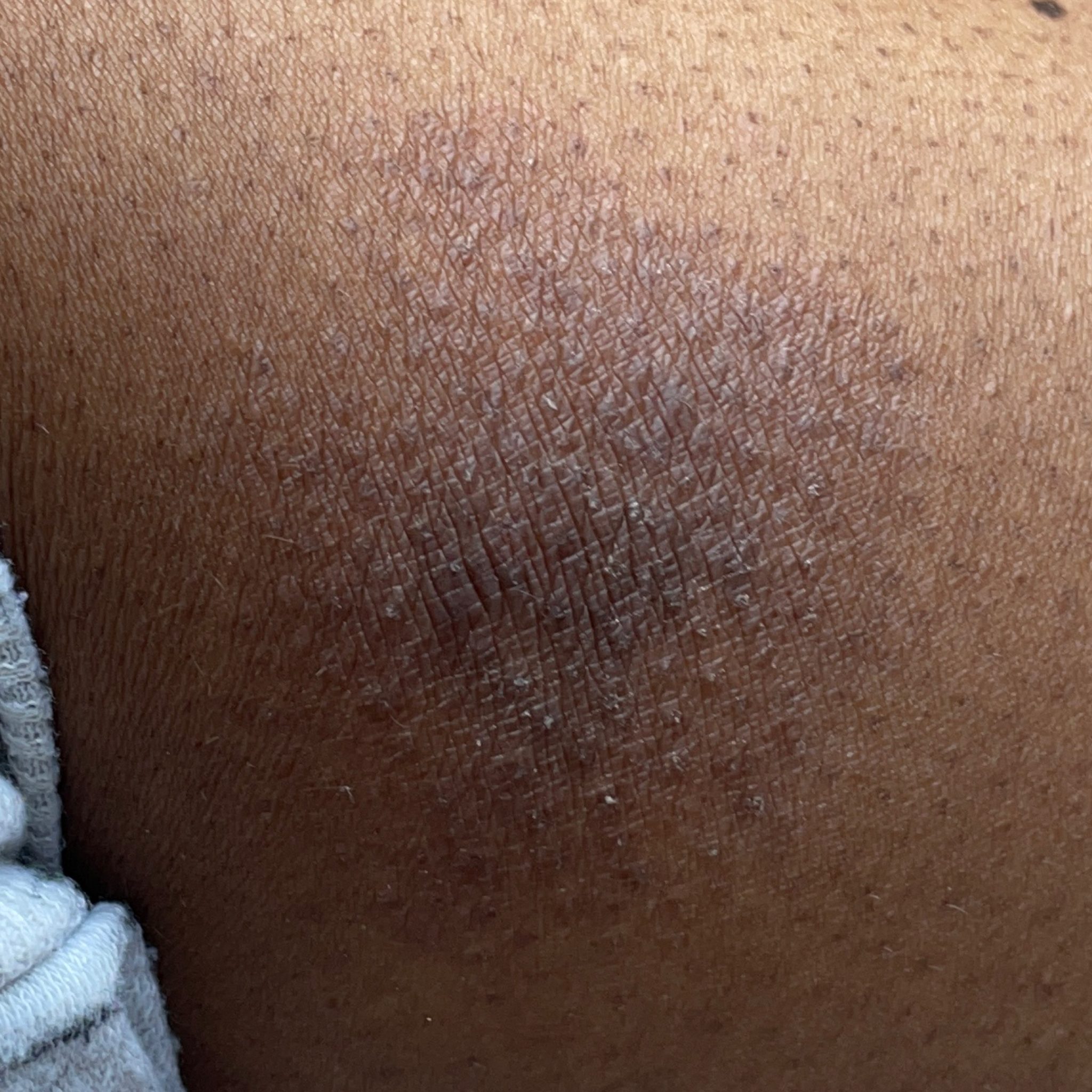 Dermatitis (ICD10 L20L30) Online AI Dermatologist