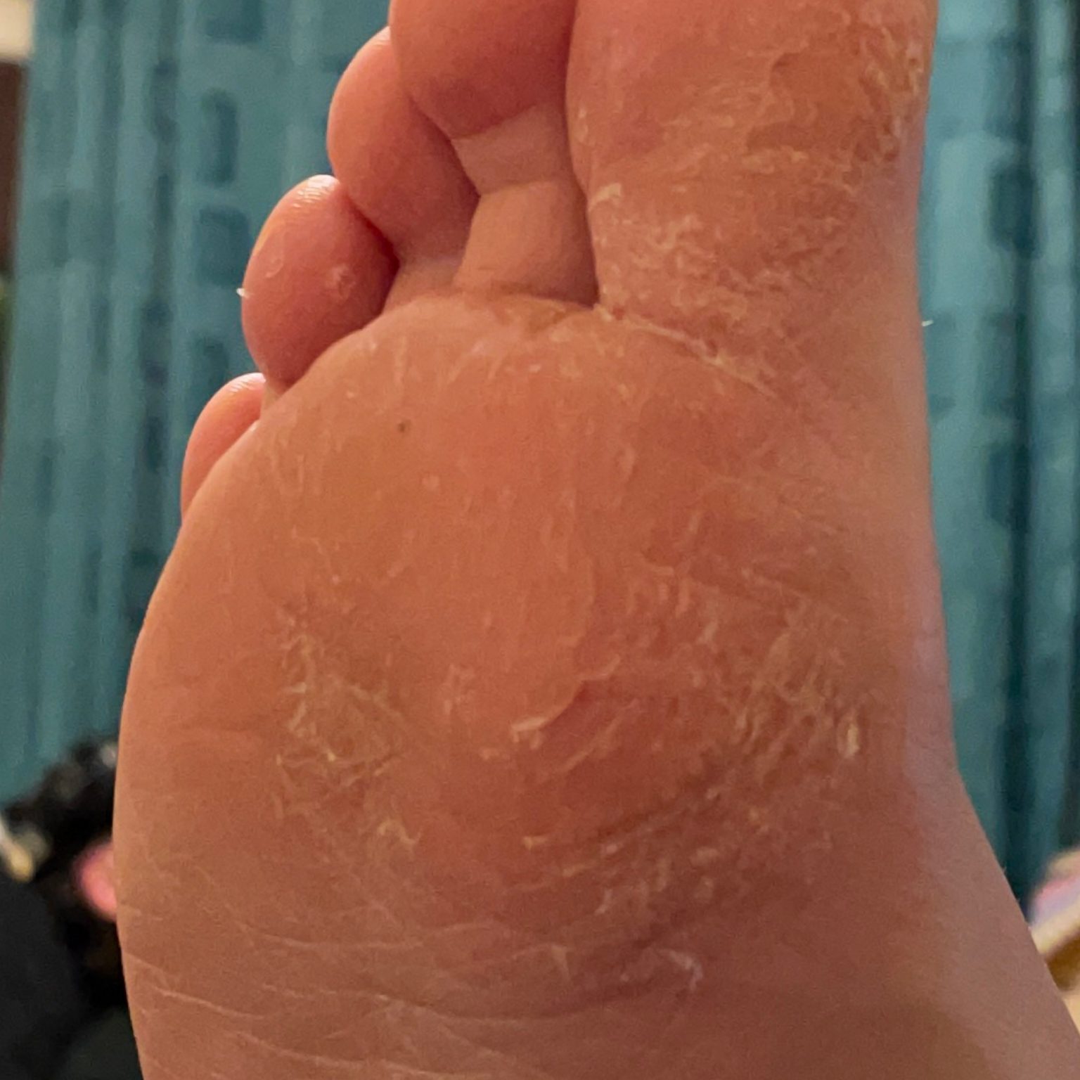 Eczema (ICD10 L20L30) Online AI Dermatologist