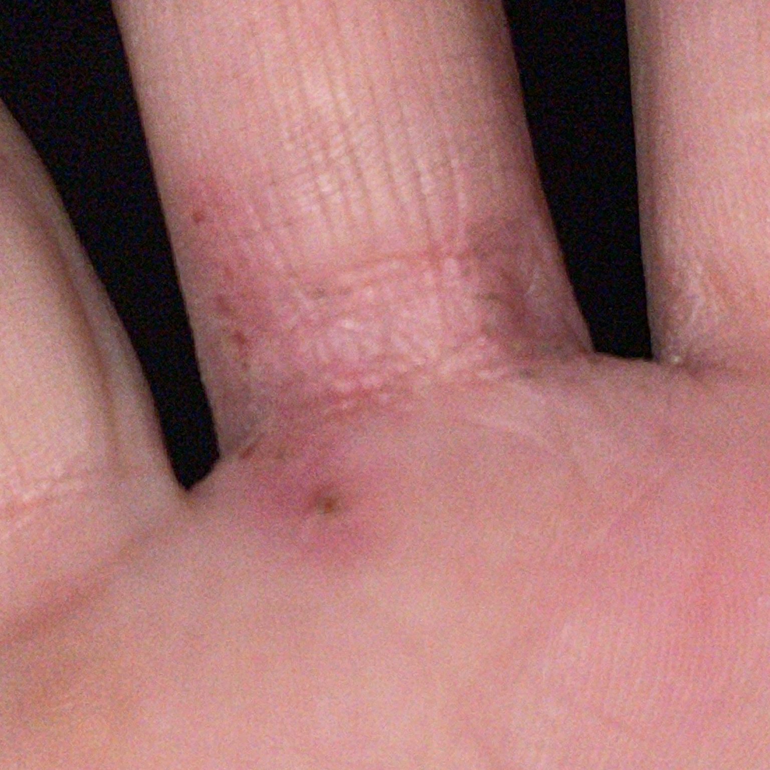 Eczema (ICD10 L20L30) Online AI Dermatologist