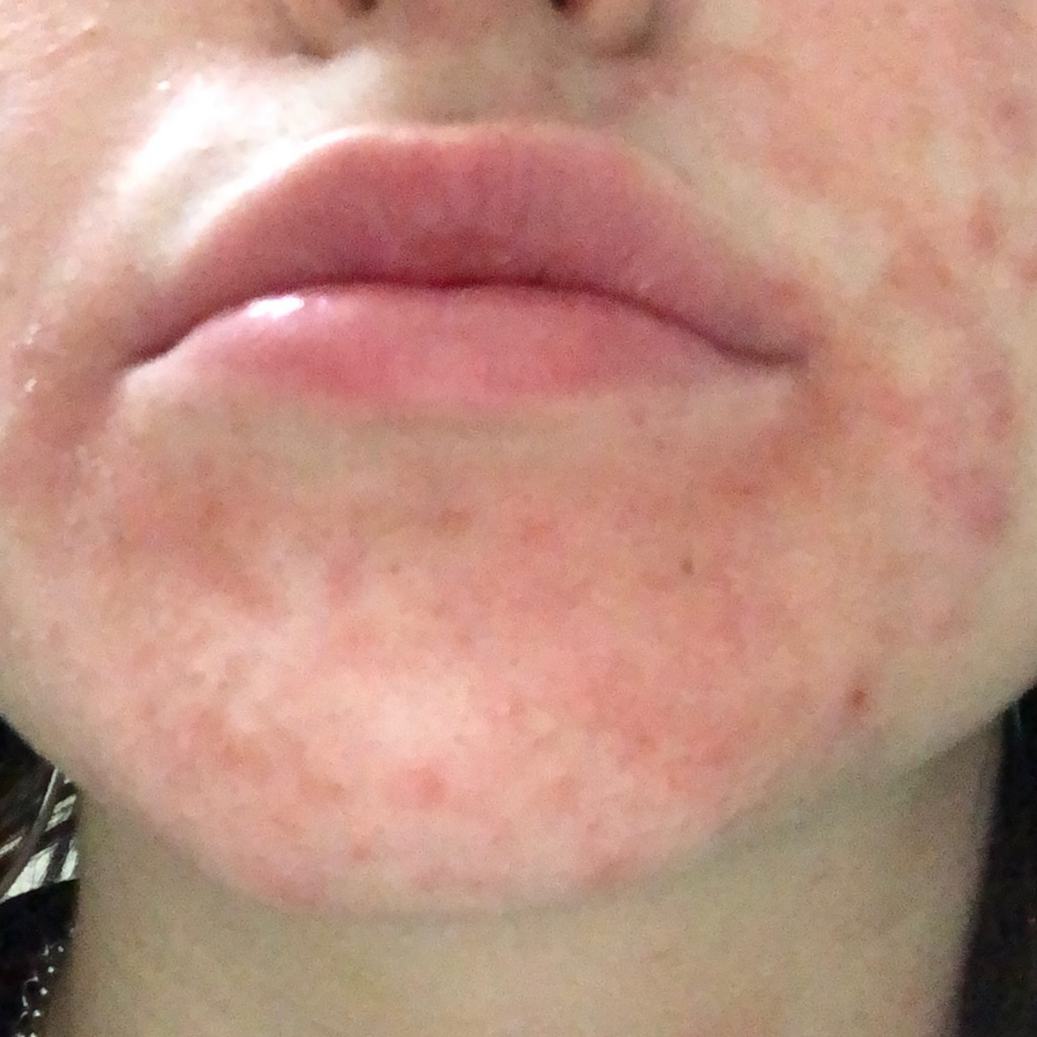 Dermatitis (ICD10 L20L30) Online AI Dermatologist