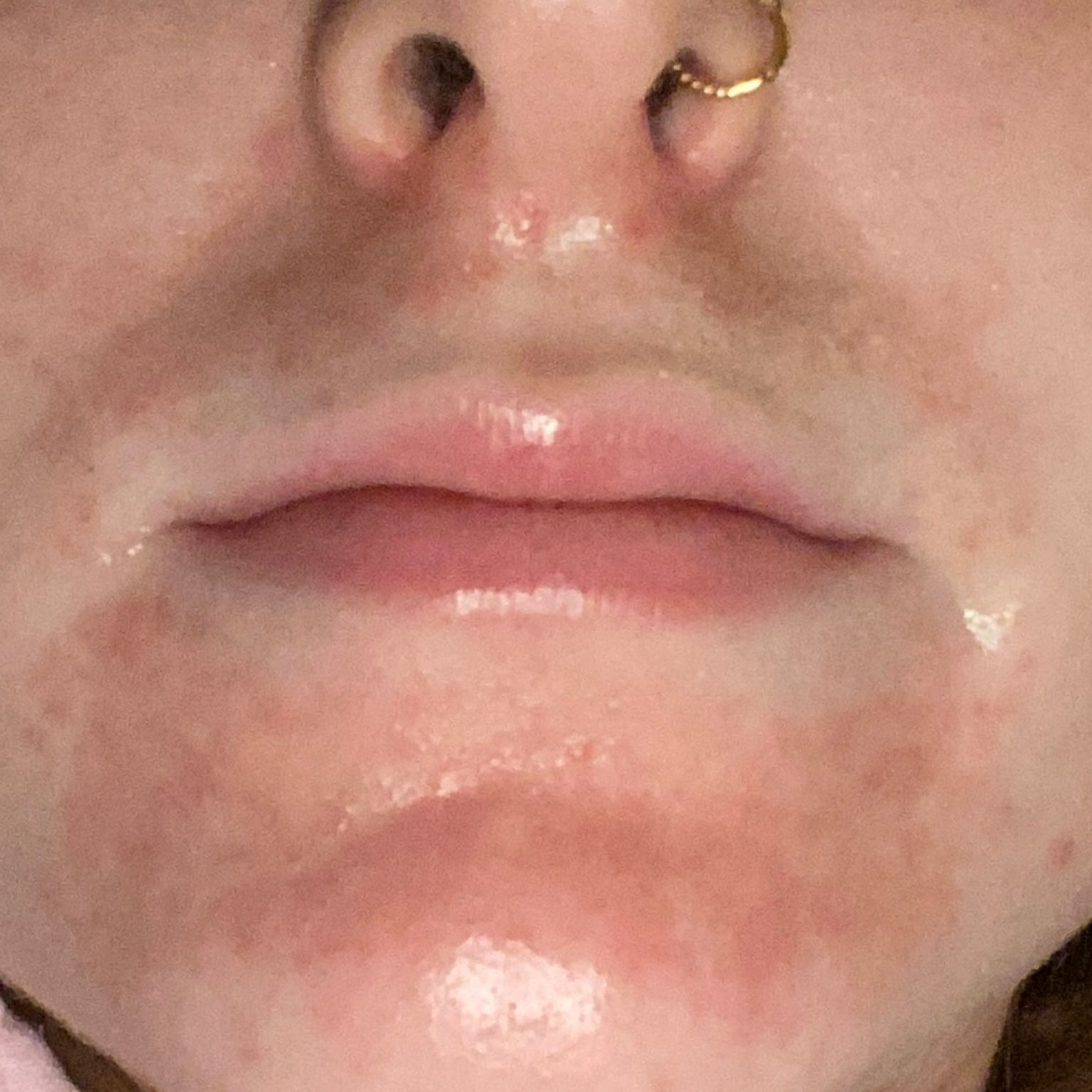 Dermatitis (ICD10 L20L30) Online AI Dermatologist