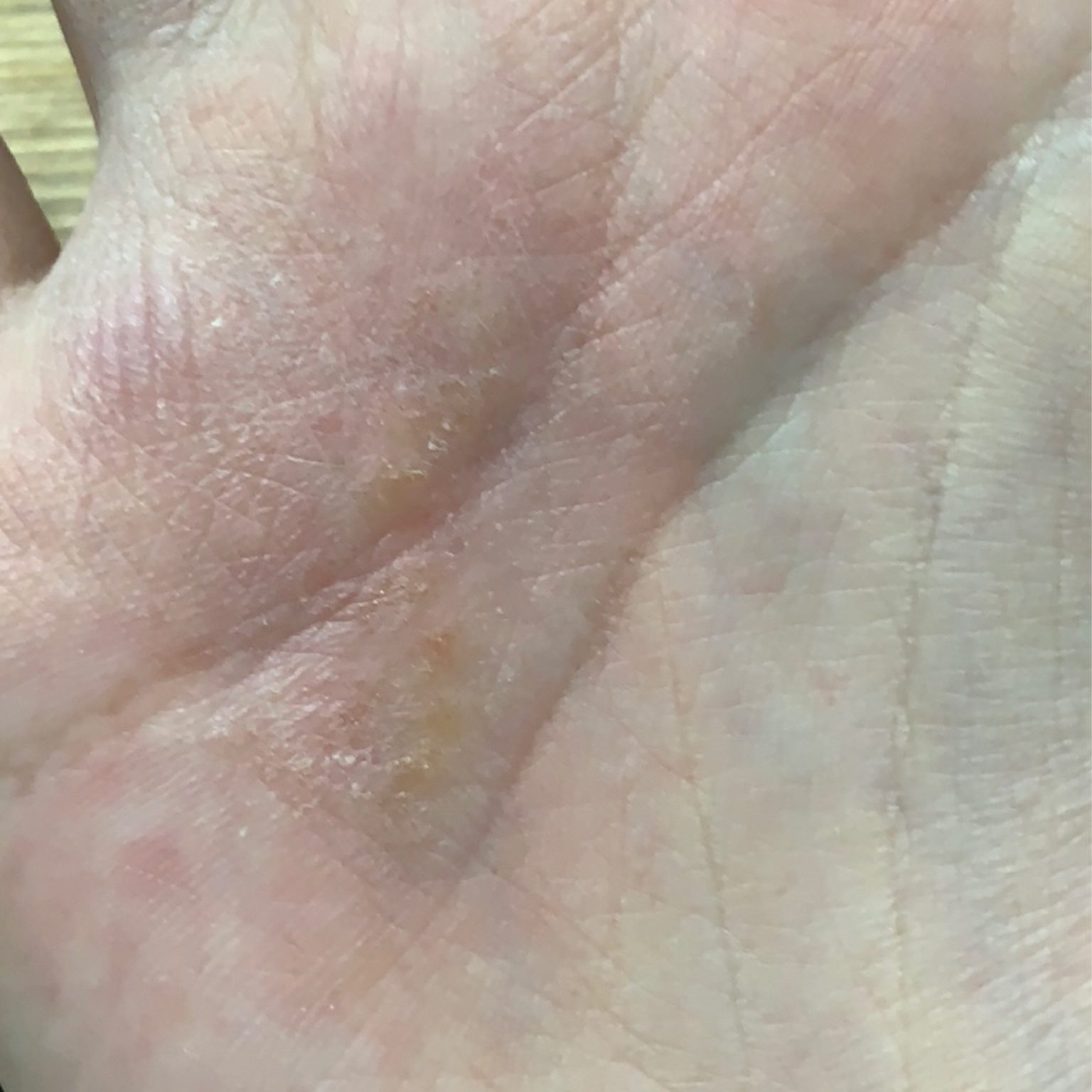 Eczema (ICD10 L20L30) Online AI Dermatologist